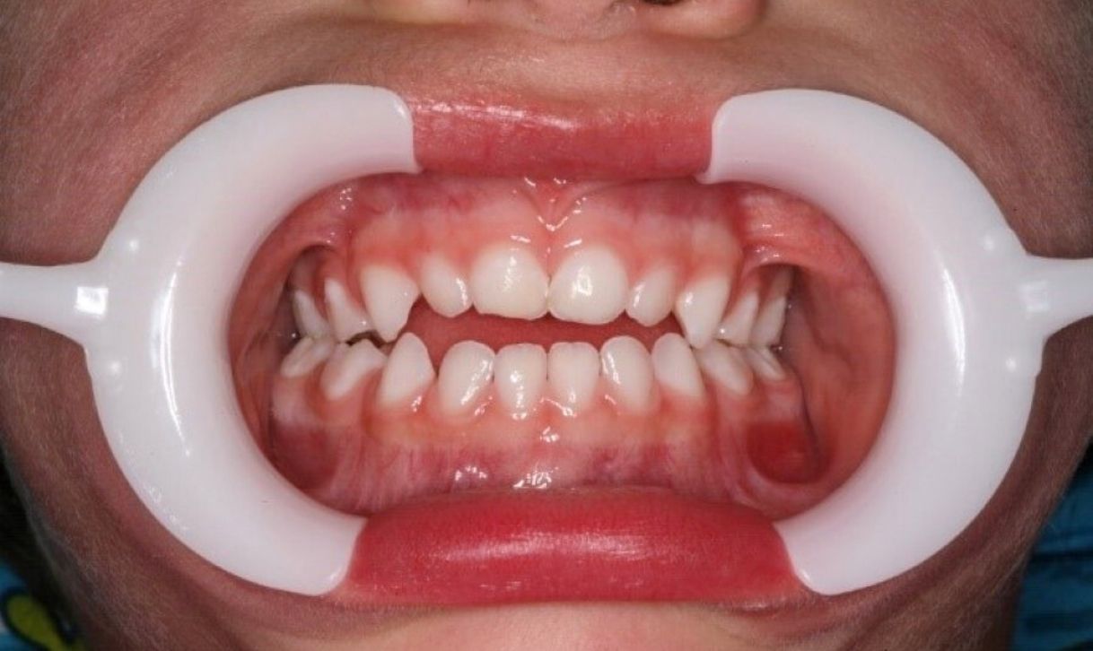 Pistas Diretas Planas